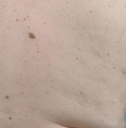 persons hairy arm after laser hair removal