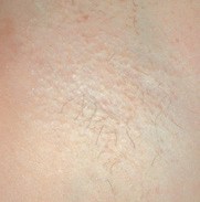 a persons hairy armpit after hair removal
