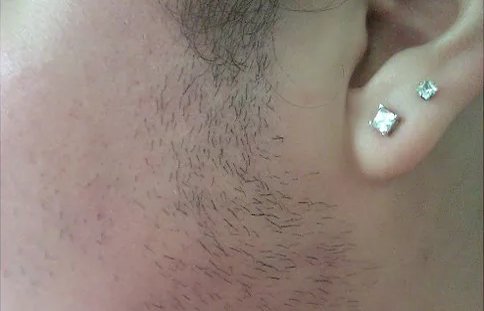 a person hairy side burns before it traetment