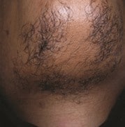 a mens chin with hair before hair removal