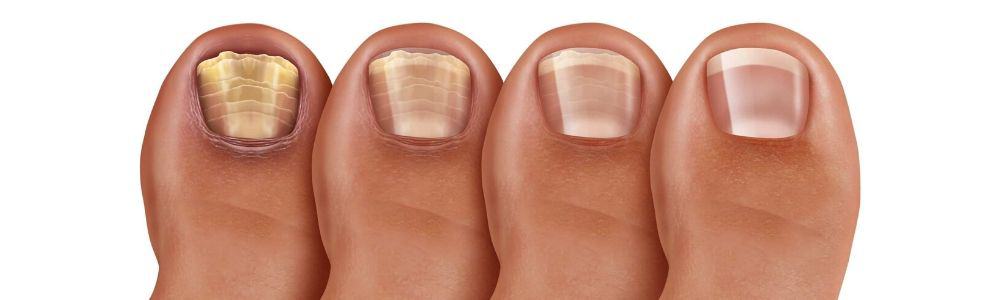 What Is Laser Treatment For Nail Fungus
