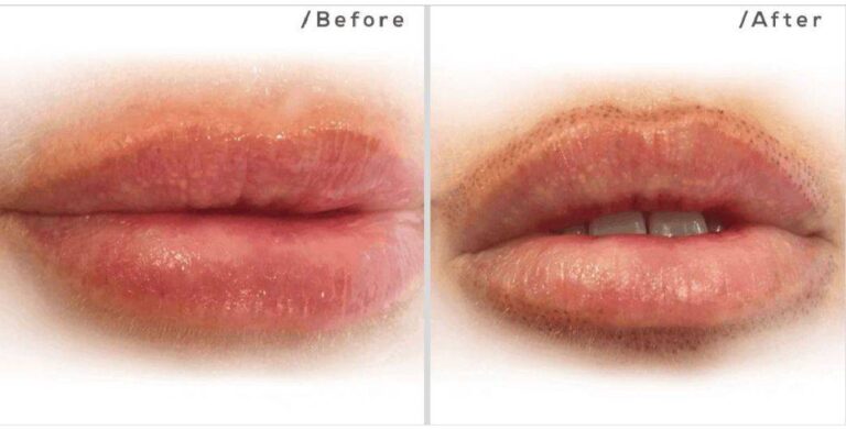 skin tightening lips