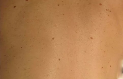 After Laser Hair Removal NYC 3