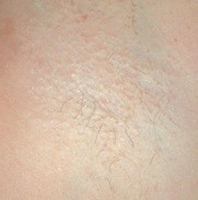 After Laser Hair Removal NYC 6