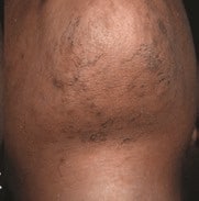 a mens chin with hair before hair removal