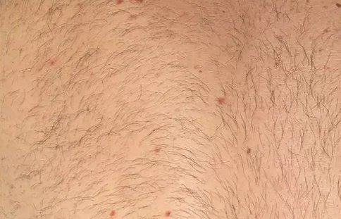 Before Laser Hair Removal NYC 3