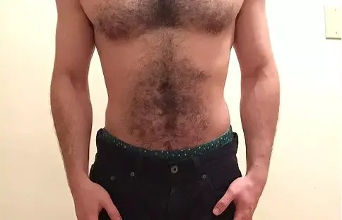 a guy with hairy chest before laser hair removal