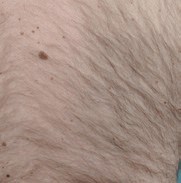Before Laser Hair Removal NYC 5