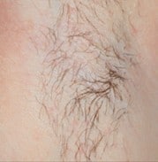 a persons hairy armpit before hair removal