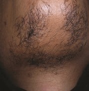 Before Laser Hair Removal NYC 7