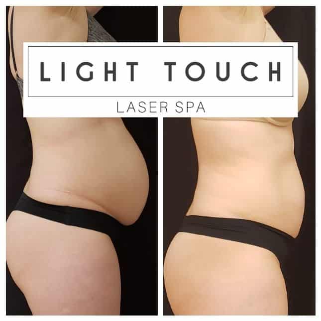 before and after fat removal