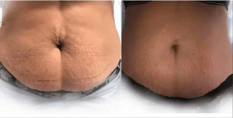 fibroblast tightening abdomen