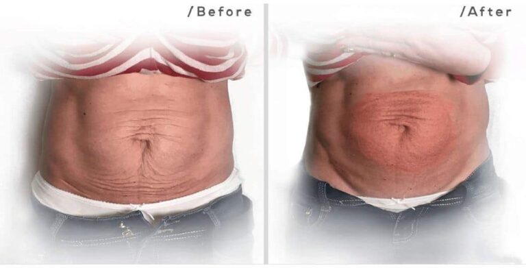 fibroblast abdominal