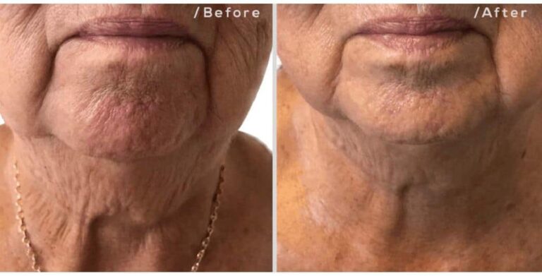 skin tightening neck