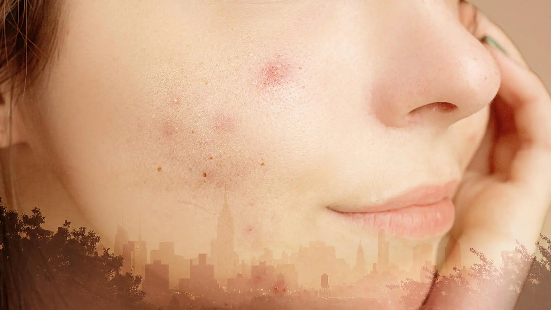 Laser hair removal is a Solution for Acne