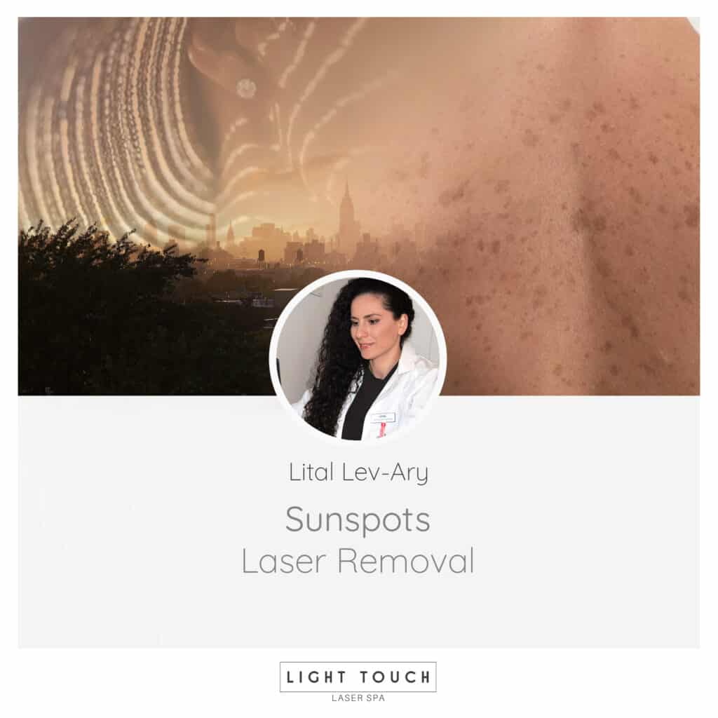 Light Touch Laser Spa NYC article Sun Spot Laser Removal advanced laser treatments