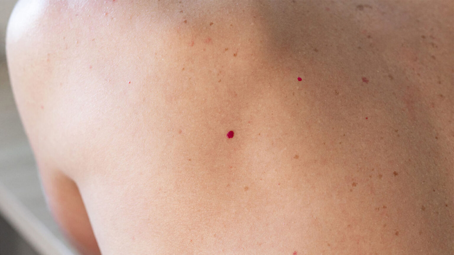 Cherry Angiomas, also known as red bumps, can appear anywhere on the body. Cherry Angiomas can be effectively remove with laser treatment - learn more on the red bump on your skin