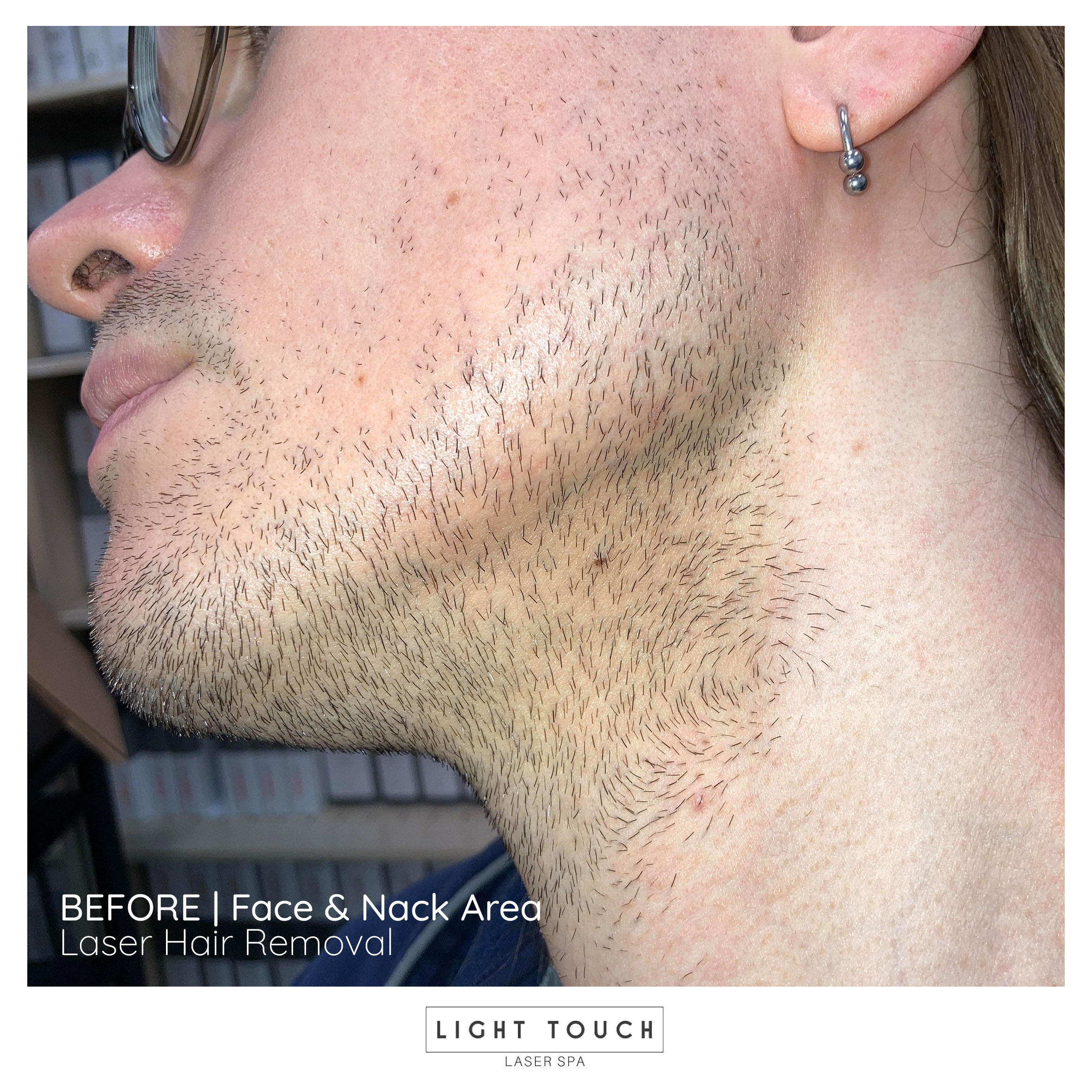 Laser hair removal treatment for transgender face and neck