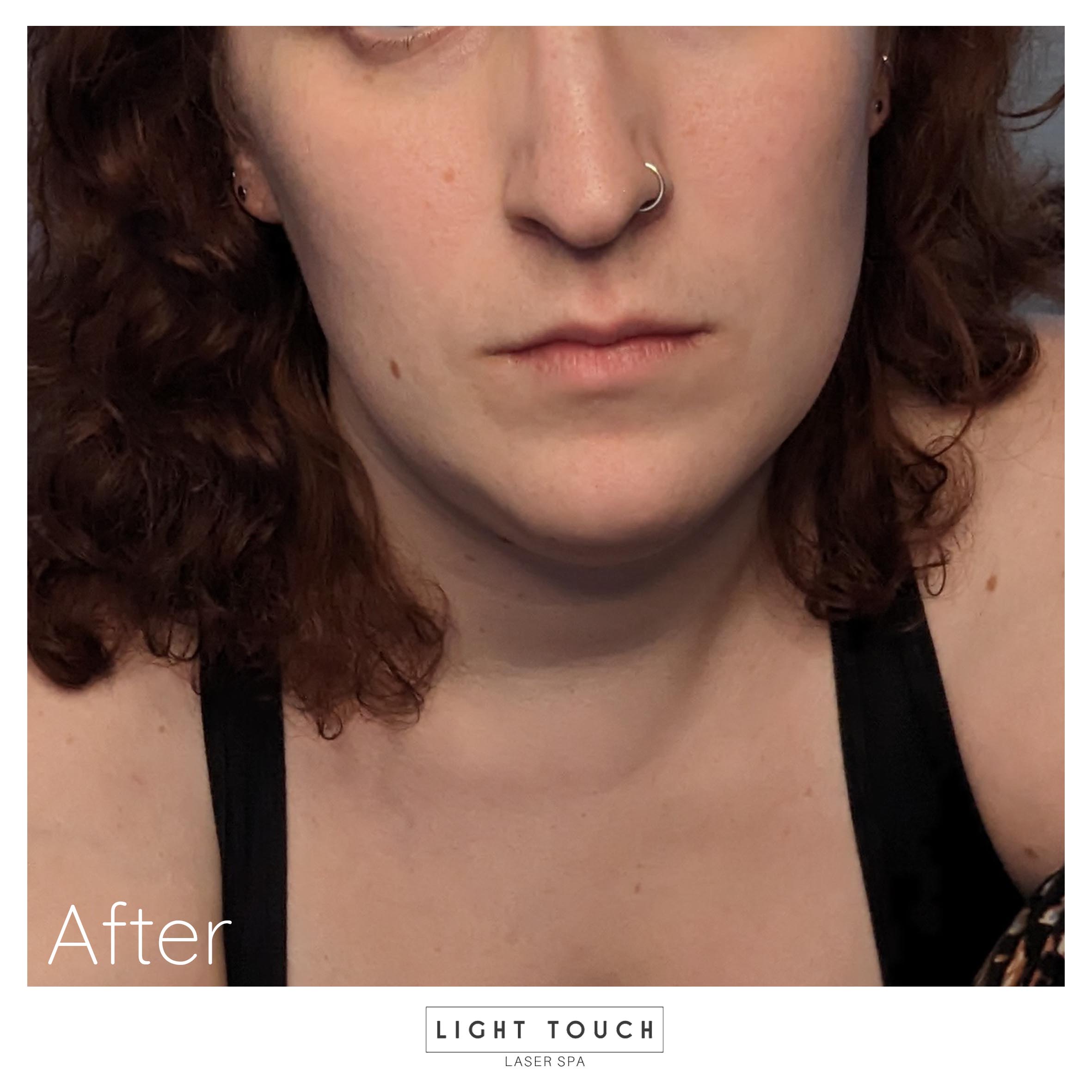 Laser hair removal treatment for transgender people in the facial area - results after