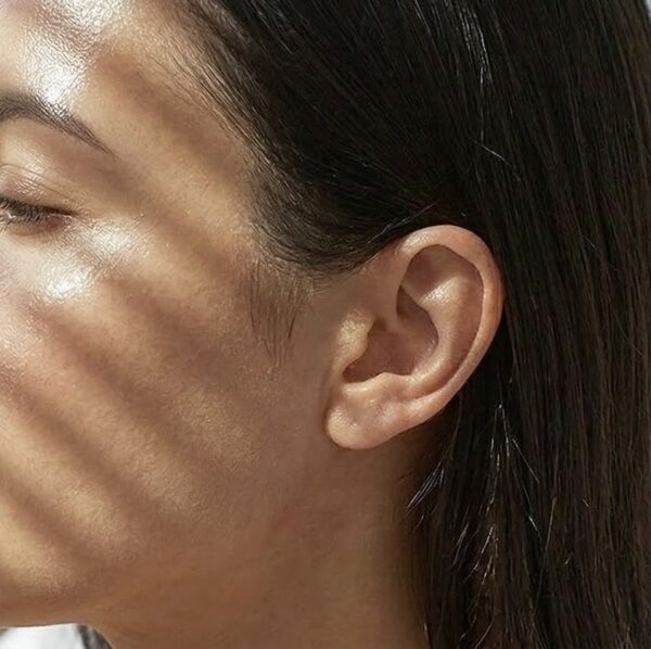 sideburns laser hair removal